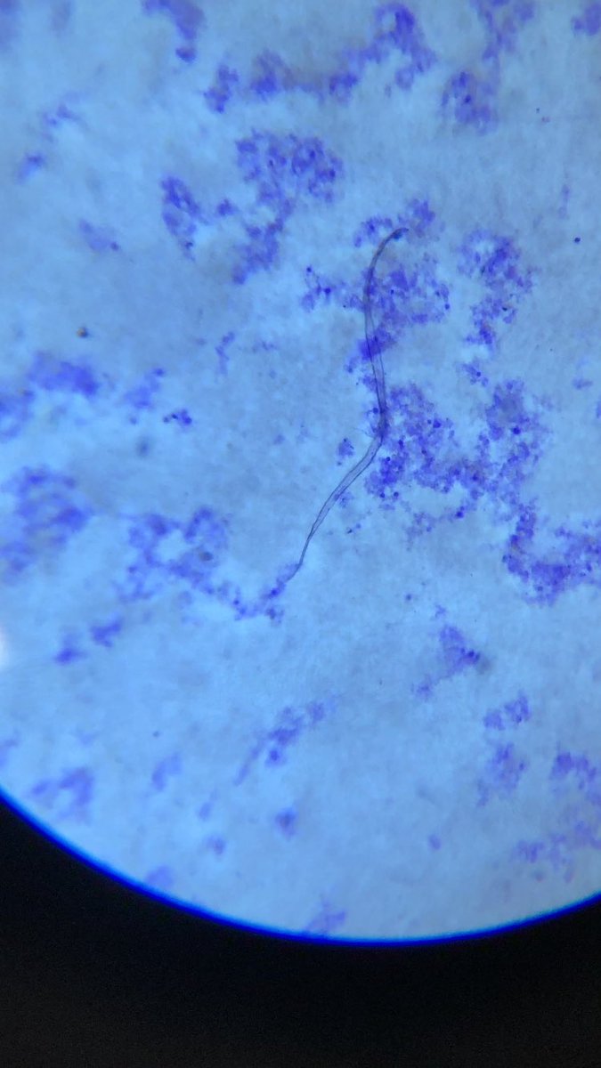 I captured some microfilaria in New Methylene Blue (supravital stain) from two different patients.

Supravital staining is a method of staining used in microscopy to examine living cells that have been removed from an organism. It differs from intravital staining.