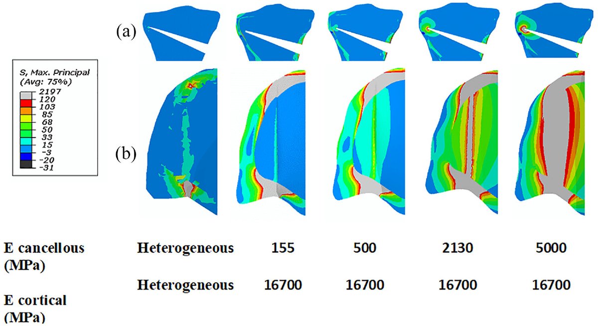 Numerical models can assess the stability of lateral hinges in high tibial osteotomy, but accurate stress prediction may not be possible. This study investigated effect of a heterogeneous versus four homogeneous models on the results of stress and force.
doi.org/10.1177/095441…