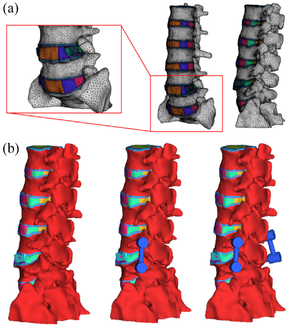 This study examines the impact of posterior supplemental fixation on facet micromotions, cage loads and load-patterns at adjacent levels in a L4-L5 Extreme lateral interbody fusion at early and late fusion stages.
doi.org/10.1177/095441…
#spinebiomechanics #lumber