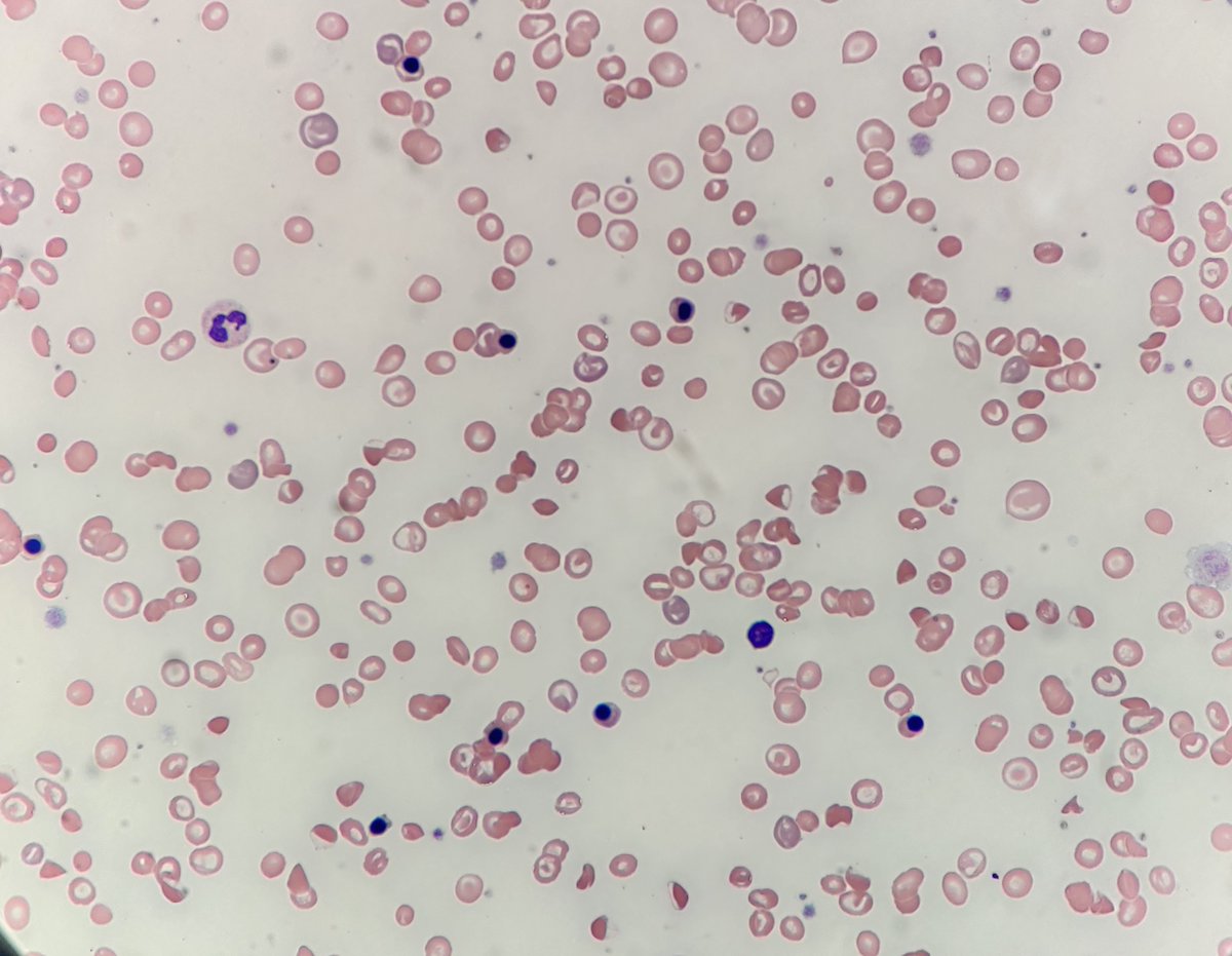 #MorphologMonday

Today is #WorldSickleCellDay so here's a case.  🧵

These images are from a 40-something year old patient who was known to have sickle cell disease. They came to clinic and their results were abnormal. [1/2]

#OnlyCells #underthescope
