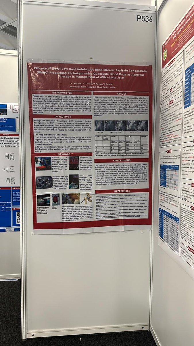 MDkamini_k's tweet photo. P536        ISBTABS-1102 
Can Blood BAG centrifuge become more useful than this ??
#Cellulartherapies 
#Clinicalapplication
#abstract selected - poster up and about #ISBTClinical #ISBTGothenburg
#adjuvanttherapy #lowcost 
#autologousbonemarrow #AVNhip
@NourAlmozain @DrRiyamia https://t.co/bxc066jd8k