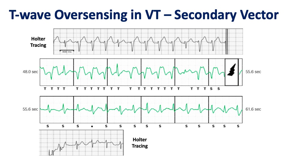 Matthew Hyman (@drmatthewhyman) on Twitter photo Holter and simultaneous S-ICD tracings show t-wave oversensing in VT (but not with native conduction) resulting in ICD therapy for slow VT.
As highlighted by <a href="/drjohnm/">John Mandrola, MD</a> <a href="/RFRedberg/">Rita Redberg</a> <a href="/bogdienache/">Bogdan Enache</a>, this is an “appropriate” shock by PRAETORIAN criteria.
#EPeeps Holter and simultaneous S-ICD tracings show t-wave oversensing in VT (but not with native conduction) resulting in ICD therapy for slow VT.
As highlighted by <a href="/drjohnm/">John Mandrola, MD</a> <a href="/RFRedberg/">Rita Redberg</a> <a href="/bogdienache/">Bogdan Enache</a>, this is an “appropriate” shock by PRAETORIAN criteria.
#EPeeps
