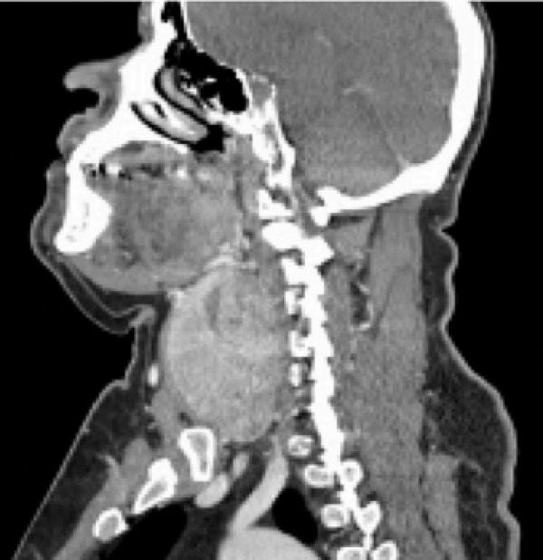 __Sara1997's tweet photo. Our recently published rare case of mixed tumors coexisting in one huge thyroid gland 👇🏻

🖇️ https://t.co/05QKtg1dqo

@Dhoha_a @jode_th https://t.co/vTkELjPLkI