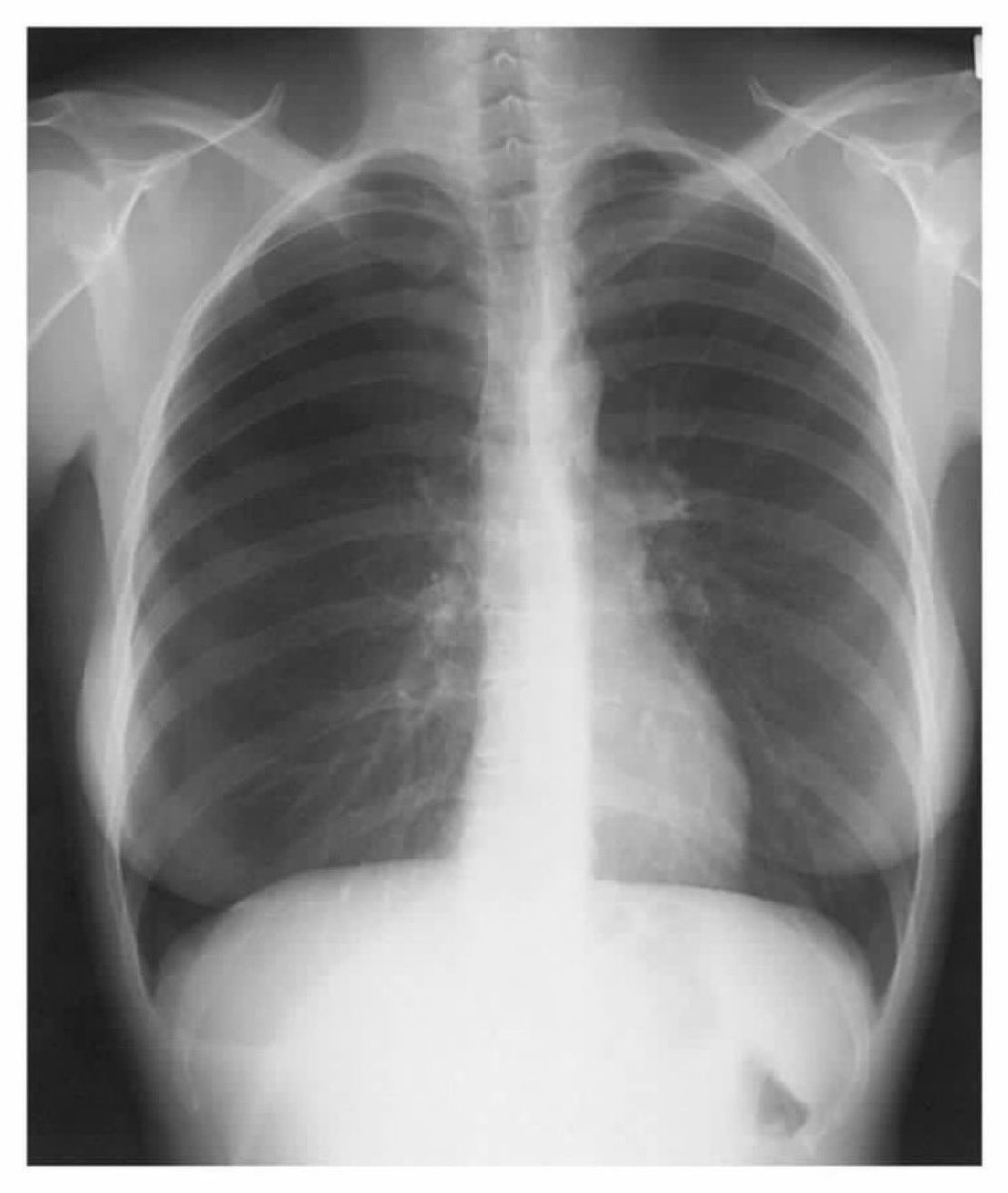 BrownJHM's tweet photo. A 38-year-old woman developed recurrent right-sided chest pain synchronously with her menses. What is the likely diagnosis? #MedTwitter https://t.co/0uKLZG7PBk