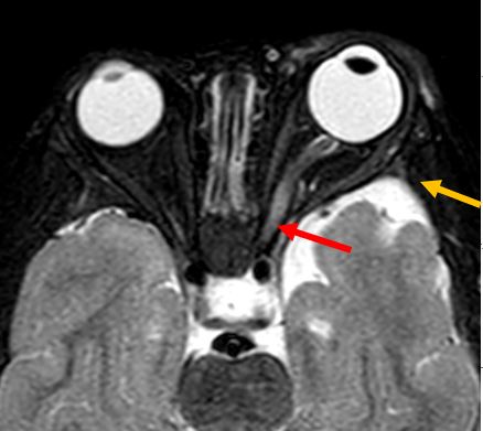 Tip of the day 💡: Look out for short segment early optic pathway gliomas (red arrow) in the context of a patient with cafe au lait spots. Note also the sphenoid wing dysplasia (yellow arrow) and the faint plexiform peri-orbital neurofibroma. All defining features of NF1.