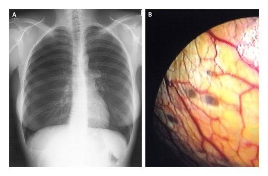 @BrownJHM Catamenial Pneumothorax

Catamenial pneumothorax is a spontaneous pneumothorax that recurs during menstruation, within 72 hours before or after the onset of a cycle

 usually involves the right side of the chest and right lung, and is associated with thoracic endometriosis.