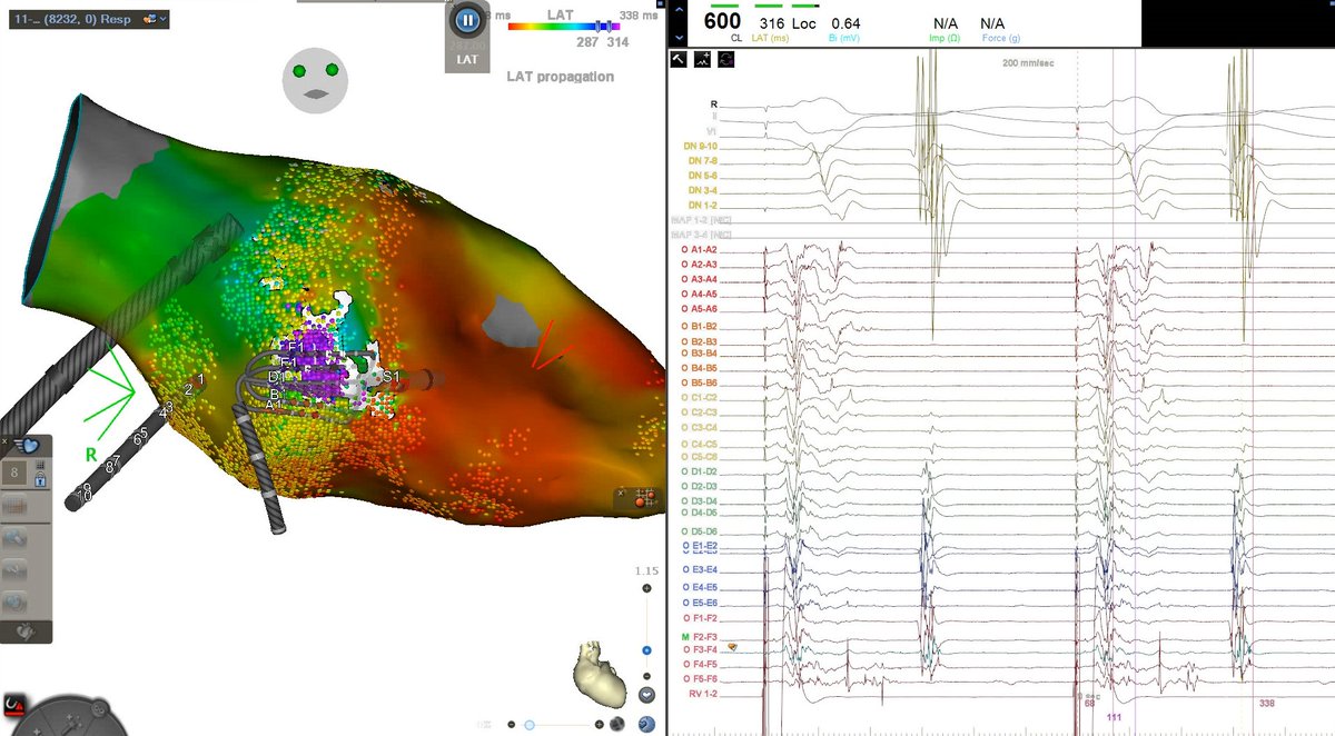 Nice scar VT with Jon Waks at <a href="/BidmcCvi/">BIDMC CVI</a>.  Crisp extreme late potentials and split LPs using the smaller Optrell 36 in an area of septal scar during RV-pacing using Late Activation Mapping in a patient with non-infarct cardiomyopathy. #ablateVT