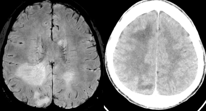 Interesting case, what is the most likely diagnosis in this 20 y/o M with waxing and waning left hand weakness and numbness? 🧠 

Answer in a few hours

#Neurology #neurosurgery @TheASNR @RSNA @Radiopaedia #radres #MedTwitter #neurotwitter