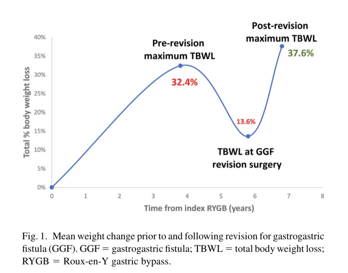 In this study, 105 patients underwent #RevisionalSurgery for Gastrogastric Fistula with higher morbidity, but significant weight loss with 18.8% TBWL after revision #SOARD23 #BariatricSurgery soard.org/article/S1550-…