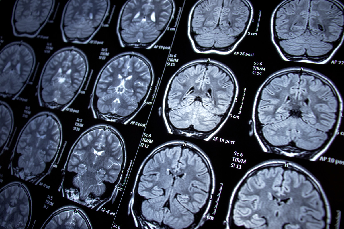 Australian Institute for Machine Learning (@theaiml) on Twitter photo <a href="/UniofAdelaide/">Uni of Adelaide</a> is seeking a postdoctoral research fellow in neuroimaging for a project to explore the potential to improve the early diagnosis and assessment of dementia — with Professor Mark Jenkinson.
bit.ly/42Ns111 <a href="/UniofAdelaide/">Uni of Adelaide</a> is seeking a postdoctoral research fellow in neuroimaging for a project to explore the potential to improve the early diagnosis and assessment of dementia — with Professor Mark Jenkinson.
bit.ly/42Ns111