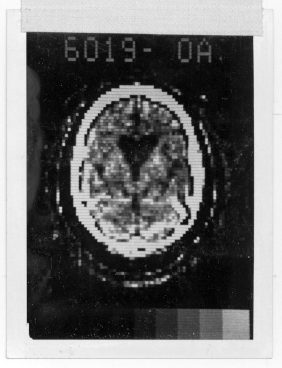 50 years ago today, @MayoClinic scanned its first patient on the second-ever CAT scanner. This new technology greatly improved brain imaging, allowing doctors to see inside patients in a way that technologies of the time could not. (Photos courtesy Mayo Clinic Archives)