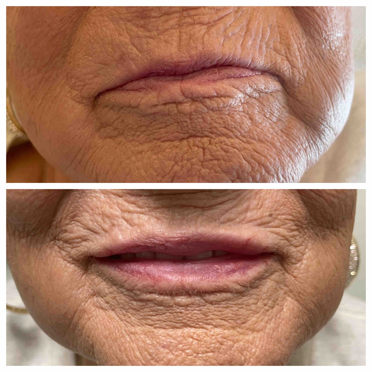 Even ladies in their 80s like to have a little “plump me up.” This is one #syringe of #Restylane #Kysse in the #lips. Results will last her about a year. #drannetrussell #seibellamedspa 501-228-6237 #fillers #antiaging #Galderma #Aspire #LittleRock❤️💋💄