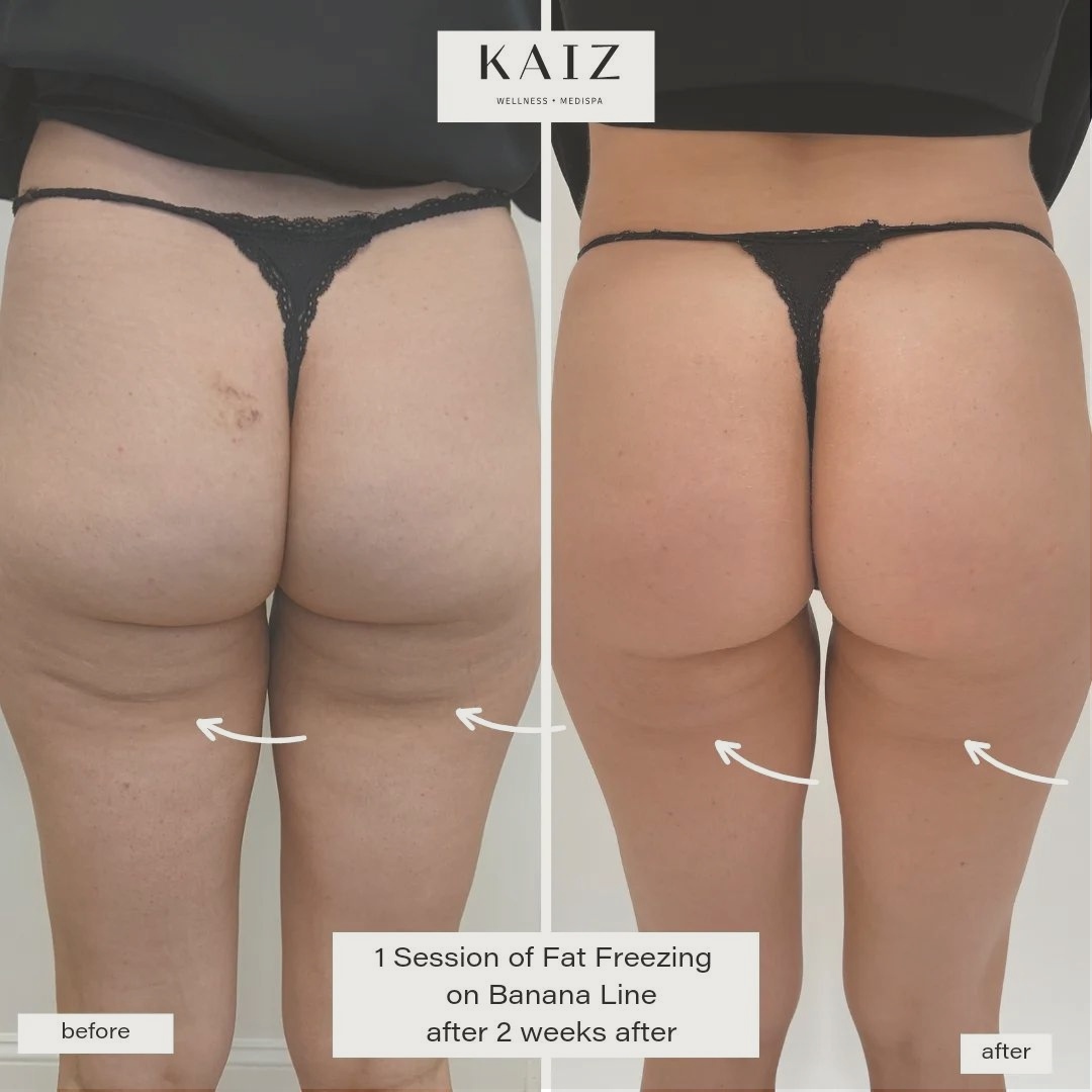 Sculpted body, here I come!

Say goodbye to stubborn fat with fat freezing. Lose inches in just a few sessions and get the body you've always wanted. 

#medspa #tummytuck #bodycontouring #bodysculpting #nonsurgical #medispa #hydrafacial #noneedle #nodowntime  #noninvasive #Kaiz