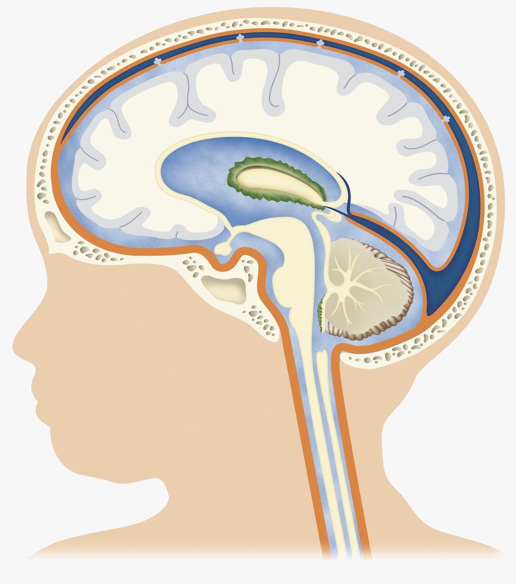 In a landmark new paper in @LancetMicrobe, @YNeurosurgery’s Steven Schiff, MD, PhD, and colleagues conclusively identify #paenibacillus infection as the cause of thousands of cases of #hydrocephalus in #Ugandan infants each year. bit.ly/3Pm7a1V