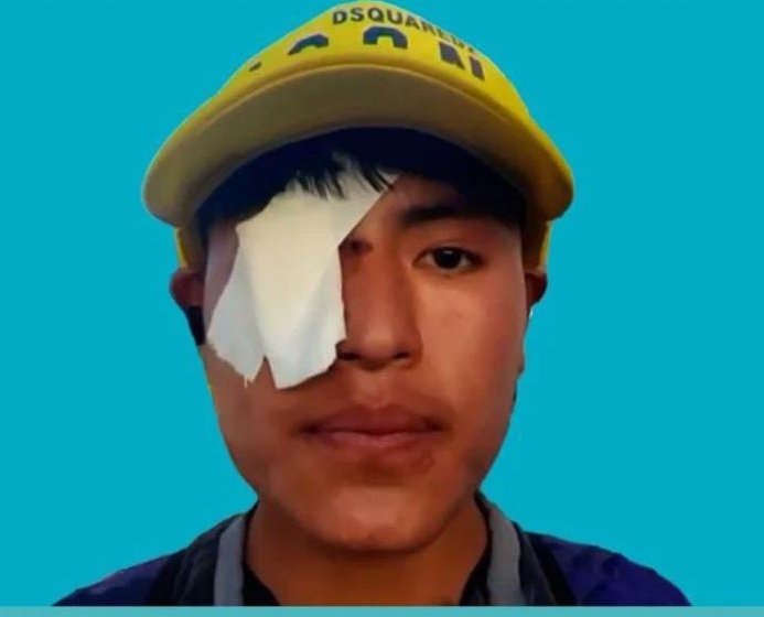 Mijael Lamas. 17 años. Perdió el ojo tras la represión a las comunidades indígenas en Purmamarca por parte de la policía de Gerardo Morales. 
La policía nos disparaba en la cara, estuve ahí, nadie me lo tiene que contar. 
Y después habla de 'violentos'.