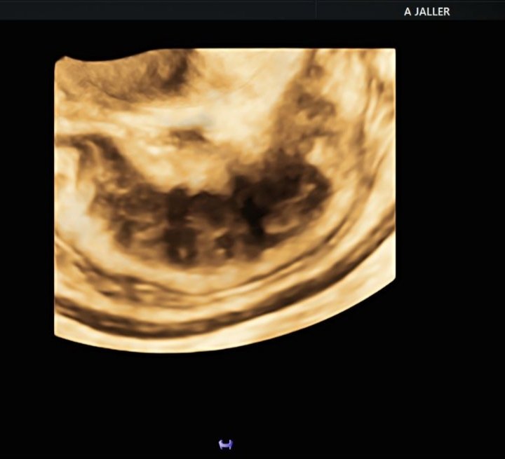 endogyneaj's tweet photo. Large nodule in the rectum and involvement of the left uterosacral ligament #endometriosis #deependo #advanceultrasound @carlos https://t.co/52Q9bI3uqs