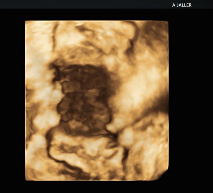 endogyneaj's tweet photo. Large nodule in the rectum and involvement of the left uterosacral ligament #endometriosis #deependo #advanceultrasound @carlos https://t.co/52Q9bI3uqs