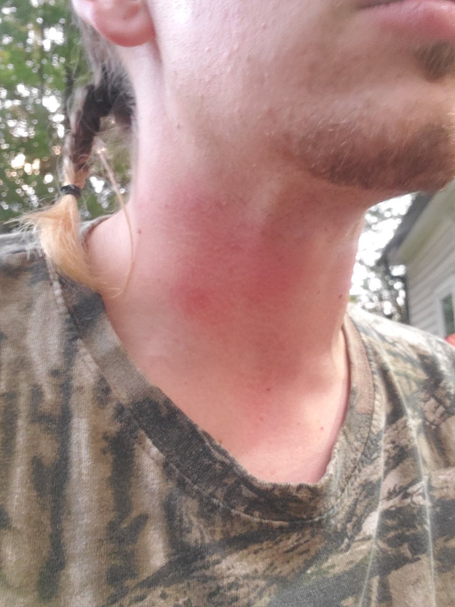 d00blord's tweet photo. out of sheer excitement I slapped chicken breasts onto a hot oiled skillet, splashing oil on my neck.  Be fooled not this is an excruciating pain and I've been humbled once more https://t.co/wgslXyln3V