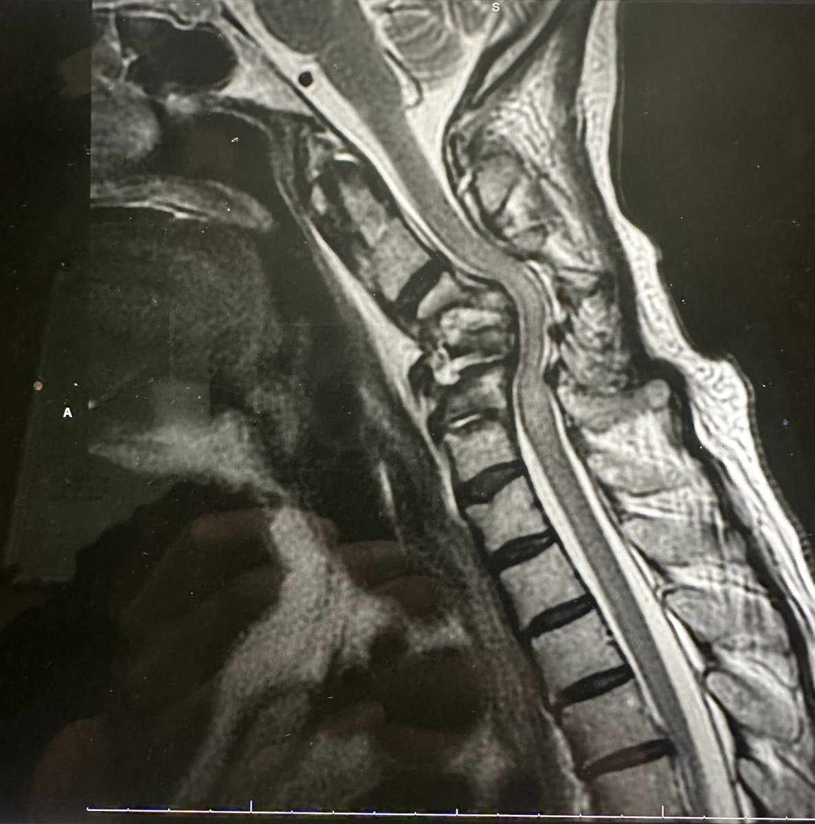#5: OU takes on the most challenging cases from the entire state. You have to push yourself, in pursuit of knowledge and in thirst for technical perfection. It was a tough battle, but thankful for spine sage <a href="/HagakureKoga/">Caple A Spence</a> as one of my leaders! #OUtopten <a href="/OU_Neurosurgery/">University of Oklahoma Neurosurgery</a>