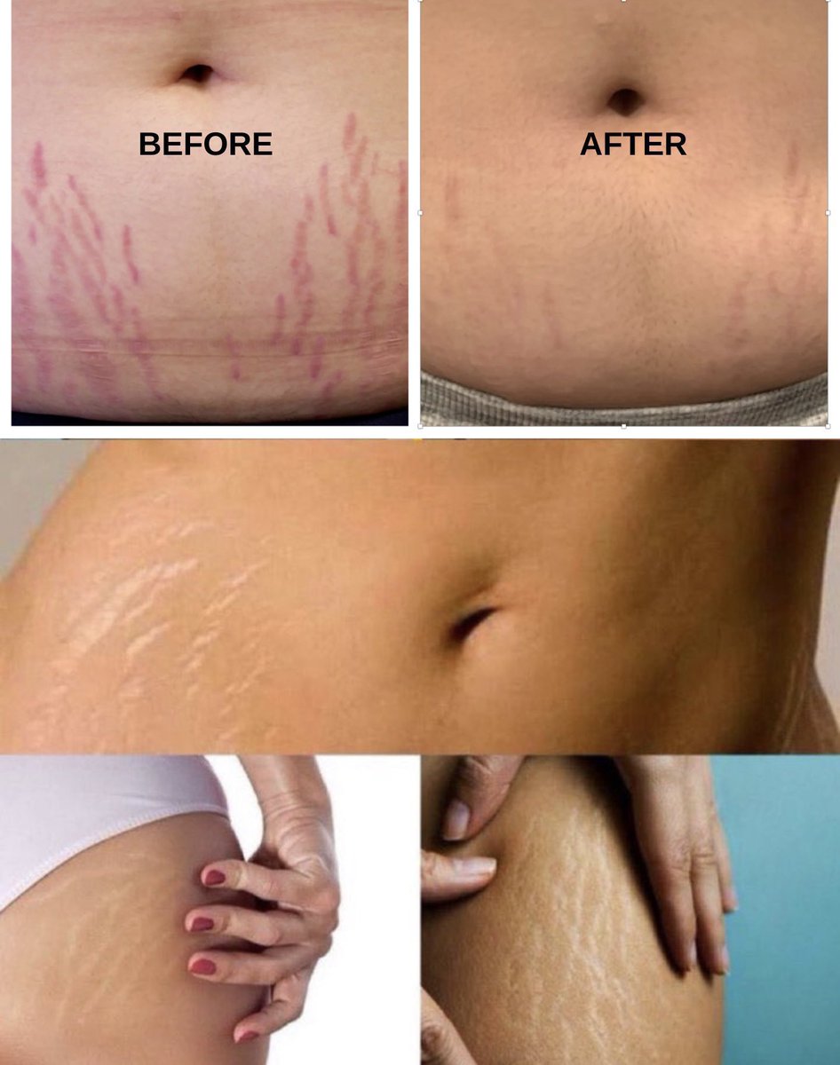 Top 5 stretch mark remover that you must try ✨

-A thread
