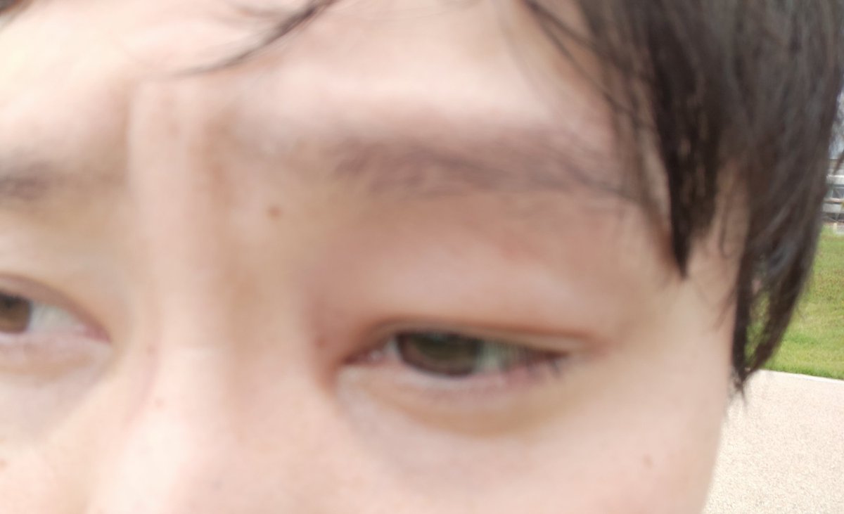 work_in_park's tweet photo. 原付走行中にハチに刺されたので記念撮影 https://t.co/7Pql4Wk9yi