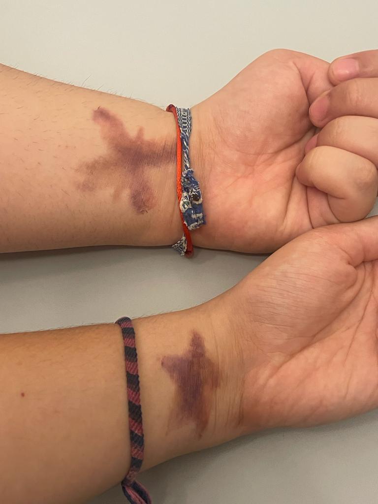 Yesterday I asked someone to put our tattoo on. They approached a group of colleagues. Seeing our bruise tattoo, one of them asked with a worried voice:"What happened?"

"How did that happen?" is the name of our campaign, and, as you see, we opted for it for a reason. 
#vwdunited