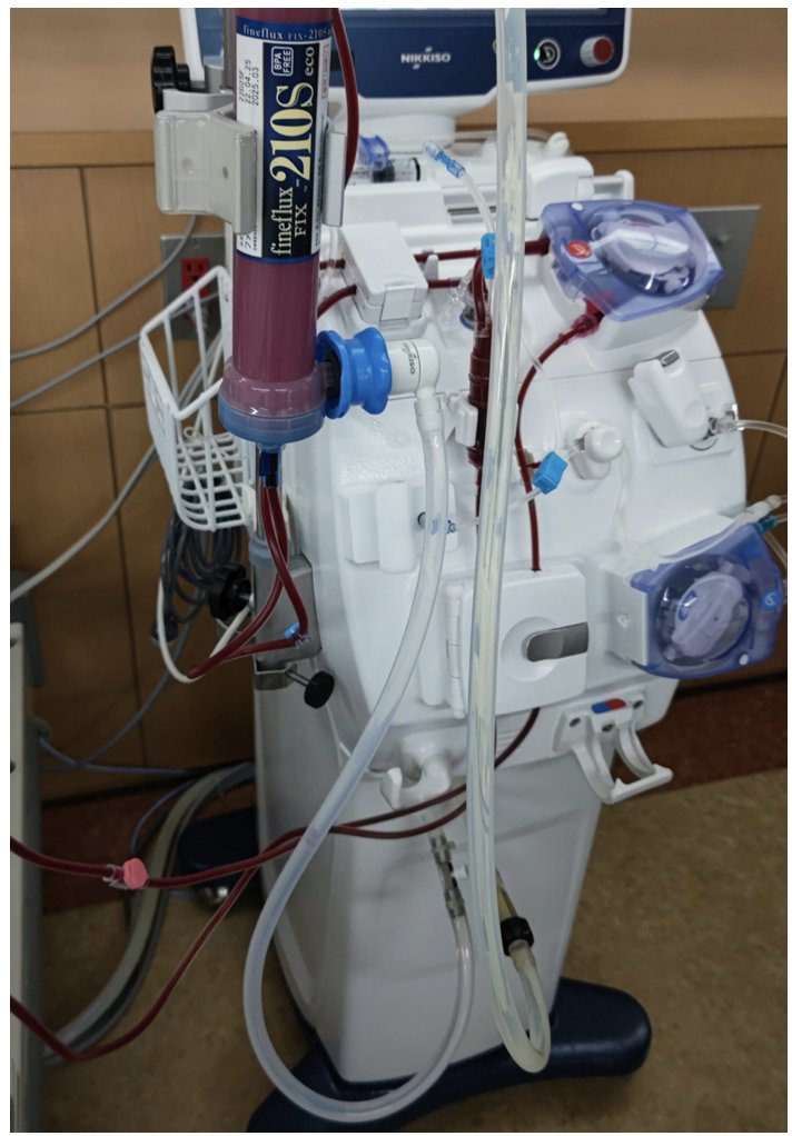 ➡️Internal Medicine Flashcard⬅️ 

Yellow-Tinted #Dialysis Drainage 

👀Can you guess the cause❓⁉️

Open access🖇️👇
ejinme.com/article/S0953-…