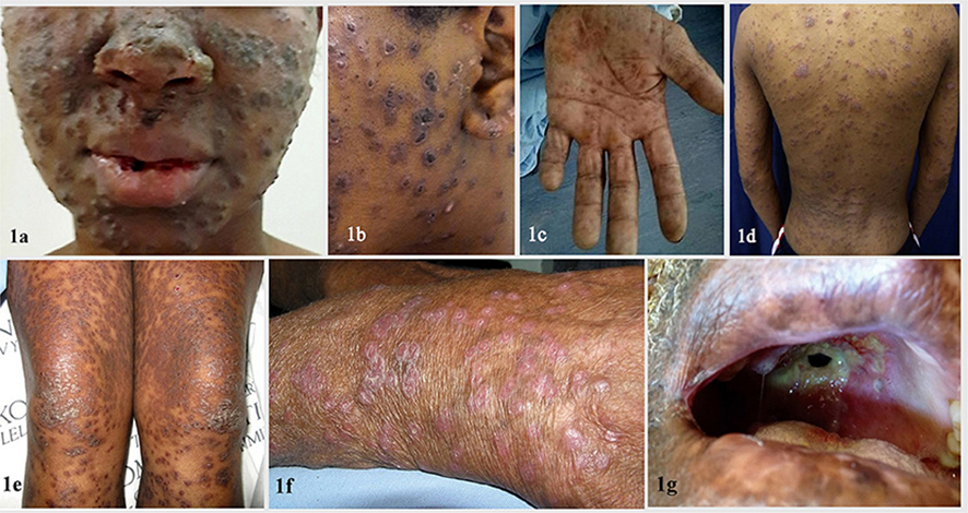 Emergomycosis, an Emerging Systemic #Mycosis in #Immunocompromised Patients in four continents: Asia, Europe, Africa and North America.
Considering the prevalence of #HIV/AIDS, must have a worldwide distribution with cases going undetected.
1/3

doi.org/10.3389/fmed.2…
#IDtwitter