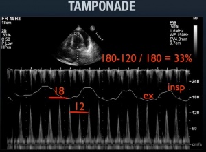 Mitral and tricuspid Doppler velocity profiles with respiratory variation 
 > 30%  

= think Tamponade.