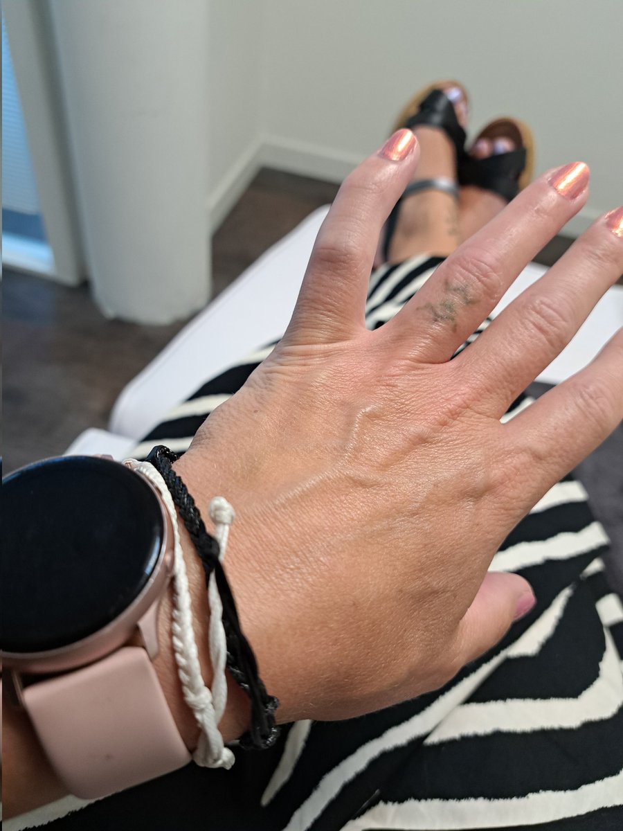 RosalieKollee's tweet photo. Weddingring removal before and after this session. They use ice before the laser shoots the inc into pieces. Now my body will clean those pieces up. This was my third session and my ex came along to see how it goes. Pretty cool huh.
#coolex #transformation https://t.co/RuKBnKbbhr
