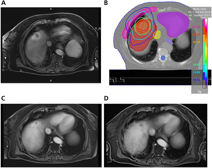 hepato_gastro's tweet photo. Traitements locorégionaux du cholangiocarcinome intra-hépatique https://t.co/SxJU3oAVvj #HGOD https://t.co/FDOtPTfljk