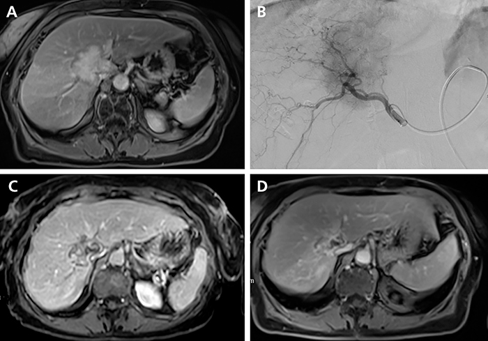 hepato_gastro's tweet photo. Traitements locorégionaux du cholangiocarcinome intra-hépatique https://t.co/SxJU3oAVvj #HGOD https://t.co/FDOtPTfljk