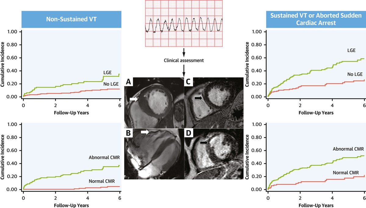 Among patients with a history of ventricular arrhythmias, how does cardiac magnetic resonance imaging affect diagnosis, management, and prognosis? Get the answer & learn more in #JACCIMG: bit.ly/43RJN4S