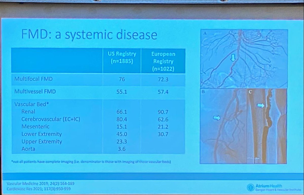 DrMarthaGulati's tweet image. Terrific Grand Rounds @SmidtHeart by @EstherSHKimMD on #FMD

📌prevalence 4-6%
💃🏻disproportionately affects women
💔multi focal most common
🧩present as HTN, stroke, tinnitus &amp;amp; seen in #SCAD 
✅&amp;gt;50% multivessel involvement
