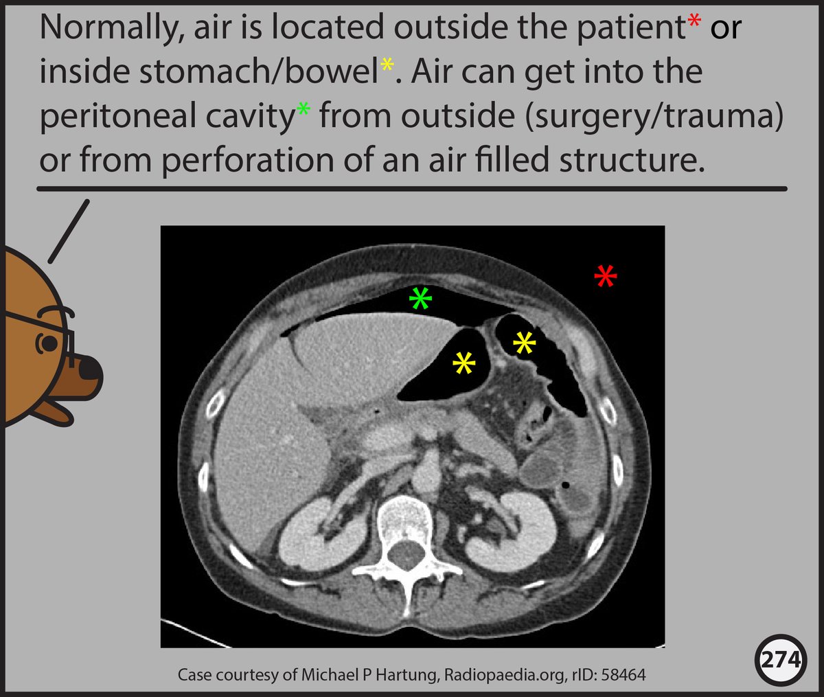 StefanTigges's tweet photo. 1/5 Interested in learning about abnormal abdominal air collections? This thread, from chapter 7 of our (@MP_Hartung ) still gestating Abdominal CT comic will help! In the meantime, if you want to learn how to read Head CTs, our free comic is available at: https://t.co/wPeVKtgGBe https://t.co/9FtHhqtsRw