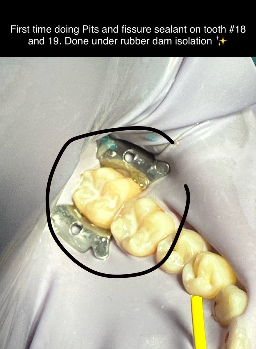 Ali243s's tweet photo. الحمدلله يارب🙏🏻
3rd year is done✅
Learned a lot from taking radiographs and diagnosing to treating patients✨
And of course thanks for our amazing faculty members at @IAUdent who worked hard during this trimesters experience
Also special thanks for the restorative department that insured a smooth transition from the pre-clinical to the clinical courses🦷