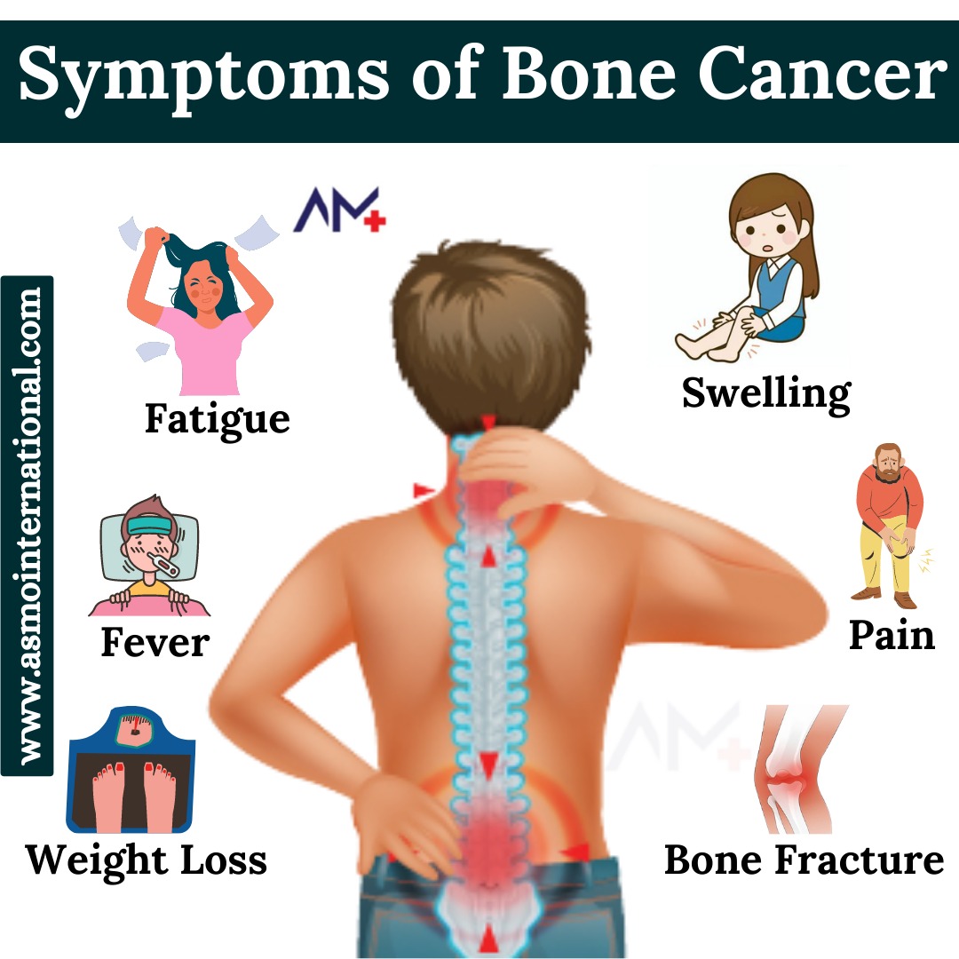 Symptoms of Bone Cancer
.
bit.ly/3nHERKo
.
#bonecancer #cancer #sarcoma #bonecancerawareness #cancerawareness #cancertreatment #lungcancer #pancreaticcancer #physicallystrong #healthcare #asmointernational #asmohealth #asmomedicines #asmocare #asmoresearch #asmo