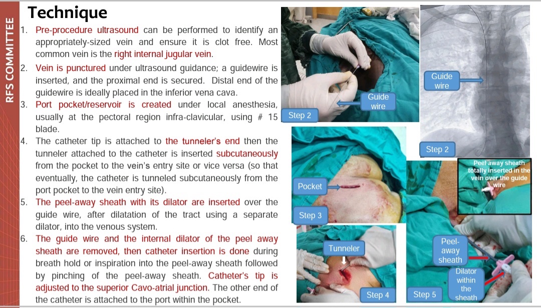 pairsmedia's tweet photo. 📣📣A new case series episode is out! 
Check out this interesting presentation about:
"Port-a-cath insertion" prepared by Raana Kanwal, reserve team. Case from ASU IR unit, Egypt.
#PAIRS
#PAIRS_RFS
#WAS_ONCE_A_BEGINNE https://t.co/lebDE4BigT