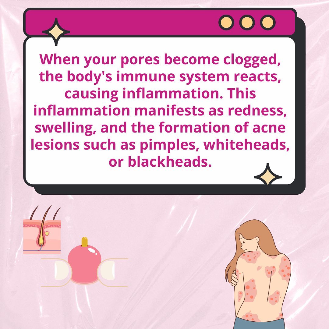 Let's understand the science between Acne & Periods!🩸
. 
. 
. 
. 
#periods #periodsandacne #pms #acneproblems #menstruation #periodstruggles