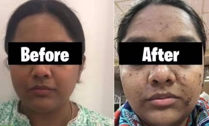 #Woman in #Mumbai underwent #HydraFacial treatment costing around INR18000, suffered #skin burns & permanent damage. She lodged #police complaint against the #salon.

#Dermatology #Cosmetics #Beauty #Parlour #Medical #Technology #Face