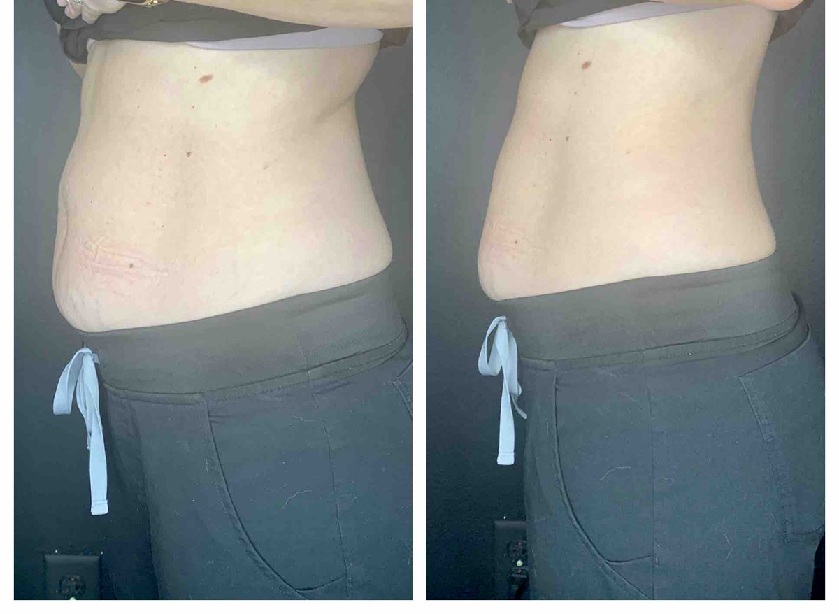 Before and after 4 sessions of #EmsculptNeo. Totally noninvasive and painless #bodycontouring using #RF to remove #fat and #HIFEM to tone #muscle. Special package pricing available. #drannetrussell #seibellamedspa 501-228-6237 #BTL #BTLAesthetics #coretofloor #LittleRock