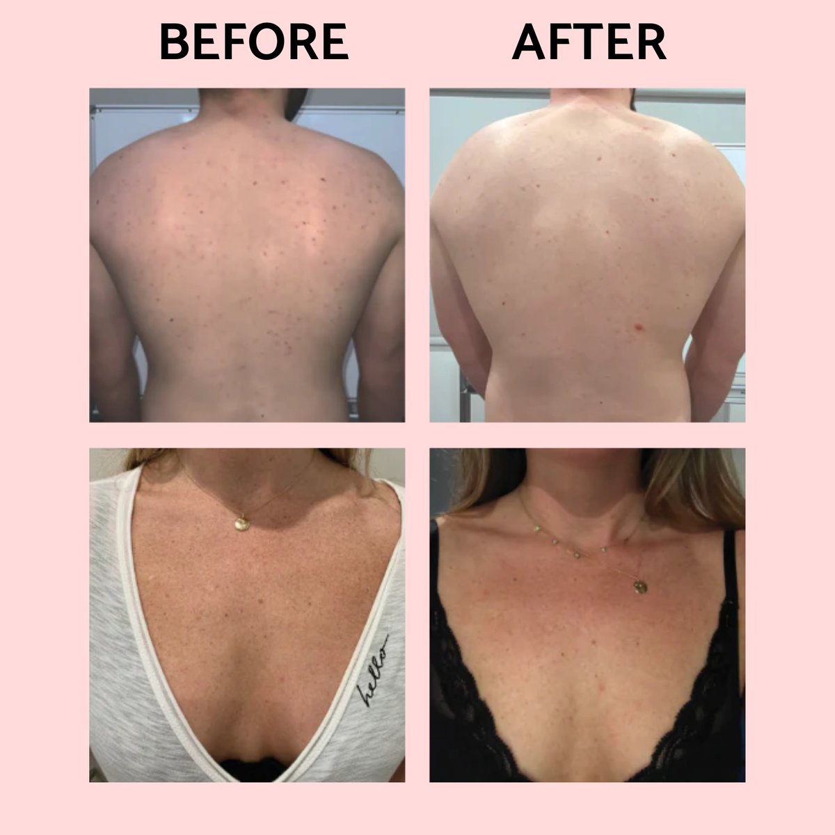 AnuMedSpa's tweet photo. NOW featuring VI Peel body!
The makers of the #1 Chemical Peel for the face, wants you to have your best body ever! The VI Peel Body treatments stimulate anti-aging collagen to increase cellular turnover. 

Price is quoted at consultation! Call 856-809-0909 to learn more! https://t.co/VQRsYZmEEA