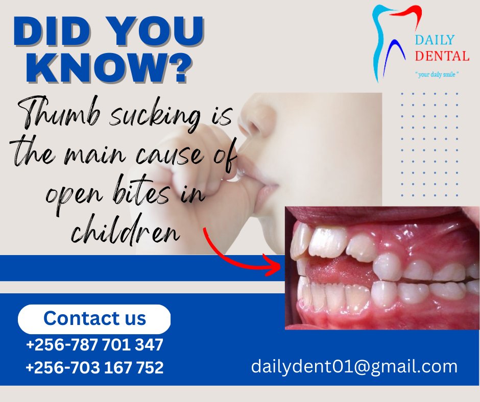 DailyDental01's tweet image. #Thumbsucking #OpenBite