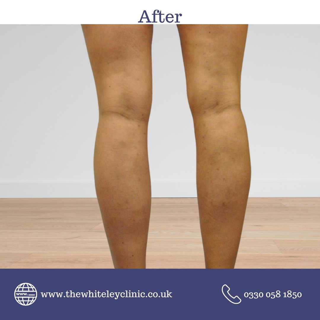 At The Whiteley Clinic, we are dedicated to delivering exceptional care and achieving optimal outcomes for our patients.
thewhiteleyclinic.co.uk

#TransformationTuesday #BeforeAndAfter #ResultsMatter #TheWhiteleyClinic #veinclinic #varicoseveins