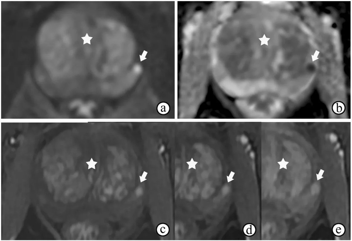 Educational Review: Differential #diagnosis of uncommon #prostate diseases - combining mpMRI and #clinical information. (Chao Han et al.)

#InsightsIntoImaging #ProstateCancer #MRI 

🔗 buff.ly/3CyYWfg