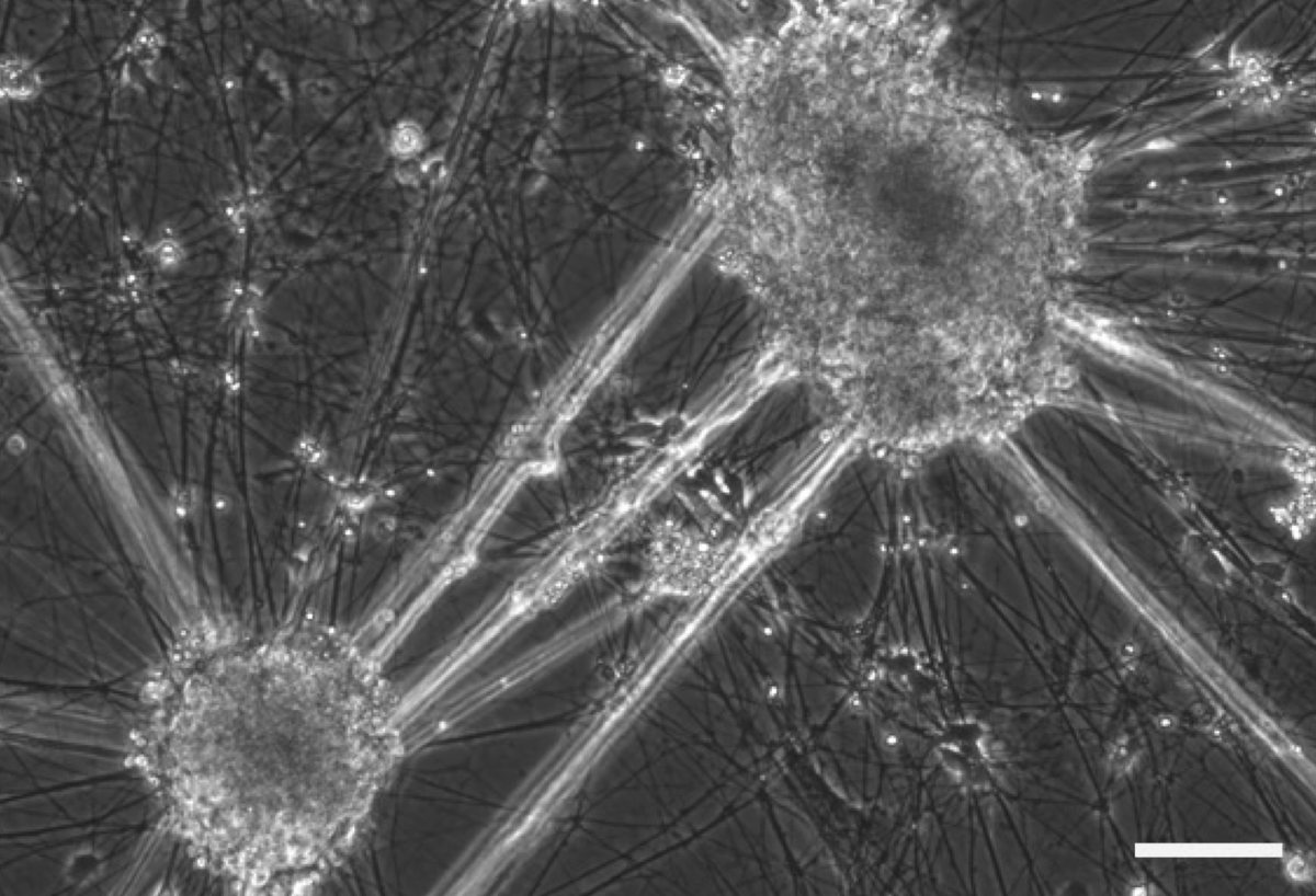Gene Therapy (@genetherapy_sn) on Twitter photo Online now, #AAV9 mediated #genedelivery of the SMn2B/- gene in #SMA #iPSC derived motor neurons in vitro and in a neonatal SMA mouse model restores SMN protein levels. Read #GTArticle here➡️nature.com/articles/s4143…
🧪: <a href="/RJYanezMunoz/">Rafael J. Yáñez-Muñoz</a>'s lab <a href="/RoyalHolloway/">Royal Holloway</a>
📸: SMA iPSC-derived MNs Online now, #AAV9 mediated #genedelivery of the SMn2B/- gene in #SMA #iPSC derived motor neurons in vitro and in a neonatal SMA mouse model restores SMN protein levels. Read #GTArticle here➡️nature.com/articles/s4143…
🧪: <a href="/RJYanezMunoz/">Rafael J. Yáñez-Muñoz</a>'s lab <a href="/RoyalHolloway/">Royal Holloway</a>
📸: SMA iPSC-derived MNs