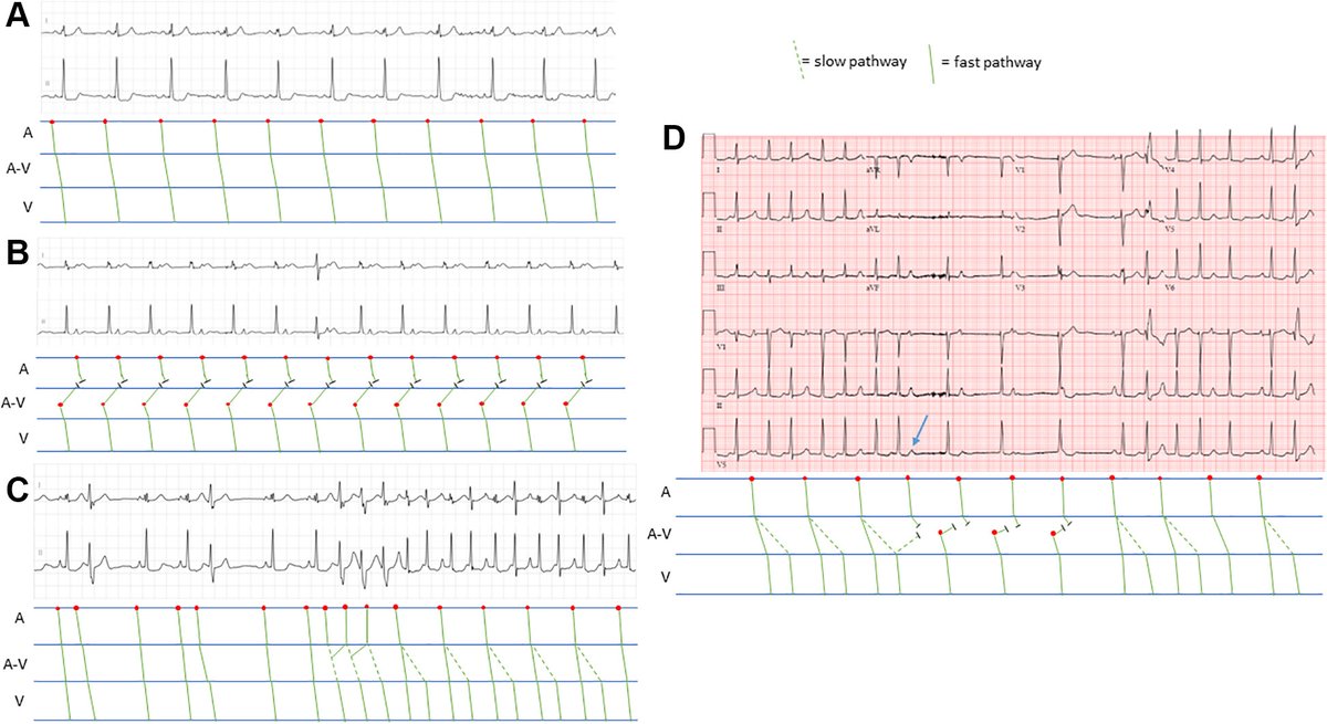 #JACCCaseReports Clinical Quiz: Here's an #ECG of a 43-year-old female patient with multiple potential causes of #palpitations.

Read more and vote below! #CardioTwitter #EPeeps @davidharmonMD