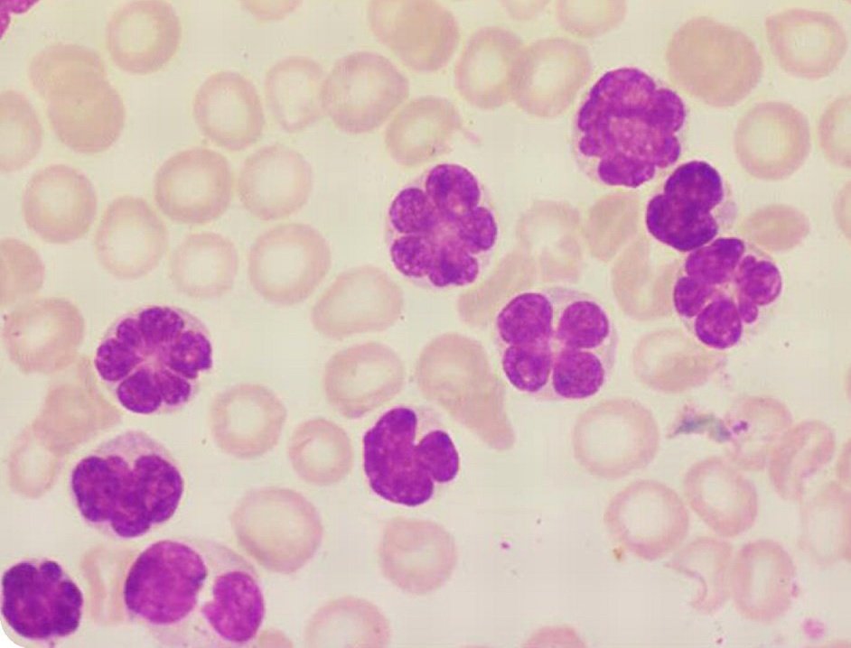 It's true,danger hides in beauty.🌸
The peripheral smear of a patient who presented with generalised lymphadenopathy& hepatomegaly is shown. What's the diagnosis?
#MedTwitter #medicine #MedEd #hematology #pathology #Clinical #Health #medicalstudents