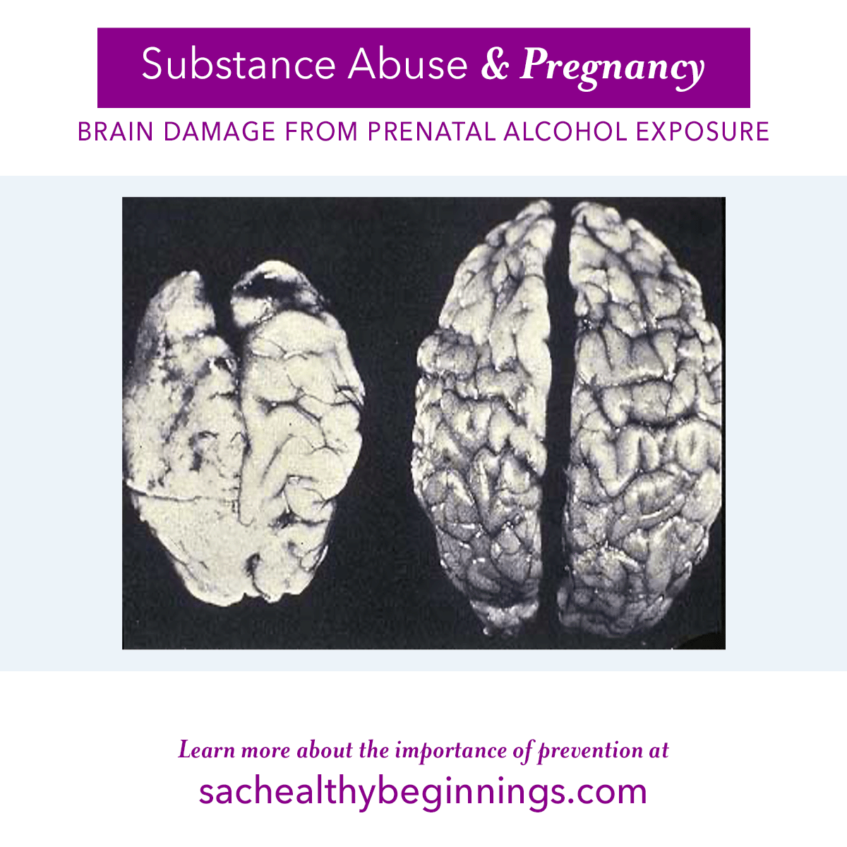 SACCountyHB's tweet image. You are looking at the brains of two 6-week-old infants. On the right is a normal brain, the one on the left is the brain of an infant that died with #FetalAlcoholSyndrome. Learn more about the importance of #prevention on our site: bit.ly/3MKMCf7 #SACCounty #Pregnancy