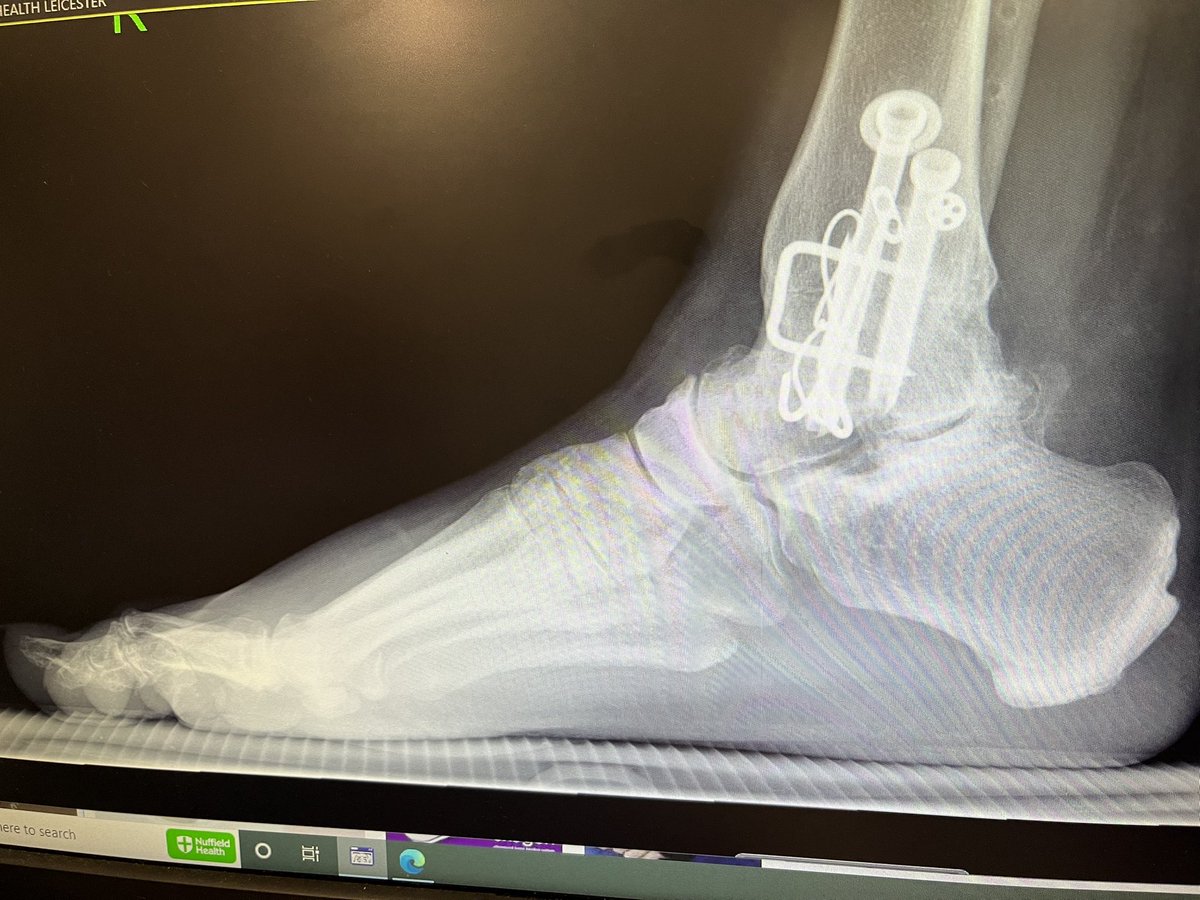OnlineSafetyHub's tweet photo. It’s my big operation tomorrow and I’m a teeny bit apprehensive! My diary is clear for the next 3 months if anyone needs any email/phone/video call advice or support. i-vengers as usual 😁
Eep! #osteotomy #MetalworkOut #FailedFusion https://t.co/HW7CLhh8Zj